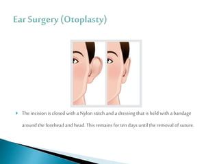 Plastic surgeon for ear reshaping or otoplasty in Lucknow