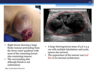 12
• Right breast showing a large
fleshy tumour protruding from
the lower outer quadrant with
most of the remaining breast
also containing tumour.
• The surrounding skin
although bluish is not
oedematous
• A large heterogeneous mass of 5.6 x 3.4
cm with multiple lobulations and cystic
spaces also present.
• The appearance of the tumour was leaf
like in its internal architecture
http://casereports.bmj.com
 
