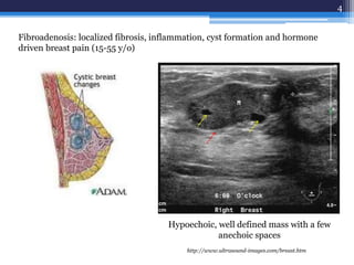 4
http://www.ultrasound-images.com/breast.htm
Hypoechoic, well defined mass with a few
anechoic spaces
Fibroadenosis: localized fibrosis, inflammation, cyst formation and hormone
driven breast pain (15-55 y/o)
 