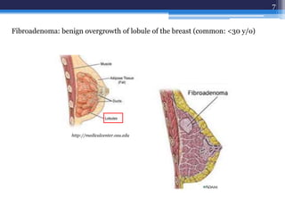 7
http://medicalcenter.osu.edu
Fibroadenoma: benign overgrowth of lobule of the breast (common: <30 y/o)
 