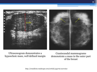 8
Ultrasonogram demonstrates a
hypoechoic mass, well defined margin
Craniocaudal mammograms
demonstrate a mass in the outer part
of the breast
http://emedicine.medscape.com/article/345779-overview
2 cm
 