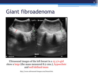 Giant fibroadenoma
9
Ultrasound images of the left breast in a 15 y/o girl
show a large (the mass measured 8.2 cms.), hypoechoic
and well defined mass
http://www.ultrasound-images.com/breast.htm
 
