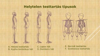 Helytelen testtartás típusok
A. Helyes testtartás
B. Kypho-lordotikus hát
E. Normál testtartás
F. Scoliosisos testtartás
E F
C. Lapos hát
D. Domború hát
 