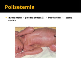 Polisetemia
 Hipoksi kronik  produksi eritrosit ↑↑  Microthrombi  cedera
cerebral
 
