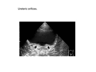 Ureteric orifices.   