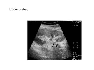 Upper ureter.  