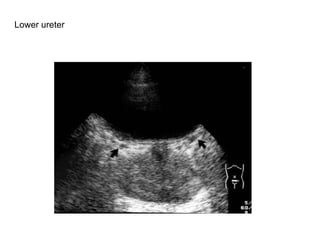 Lower ureter   
