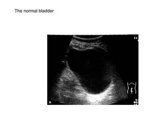 The normal bladder   