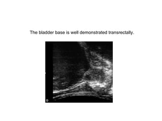 The bladder base is well demonstrated transrectally.  