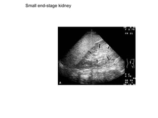 Small end-stage kidney  