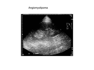 Angiomyolipoma  