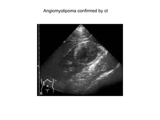 Angiomyolipoma confirmed by ct  