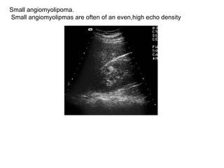 Small angiomyolipoma. Small angiomyolipmas are often of an even,high echo density  