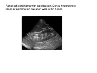 Renal cell carcinoma with calcification. Dense hyperechoic  areas of calcification are seen with in the tumor.  