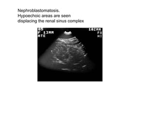 Nephroblastomatosis.  Hypoechoic areas are seen  displacing the renal sinus complex  