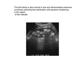 The left kidney is also normal in size and demonstrates extensive,  curvilinear parenchymal calcification with posterior shadowing  in the region of the medulla. 