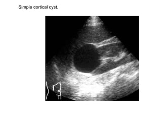 Simple cortical cyst.  