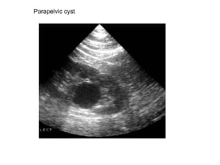 Parapelvic cyst  