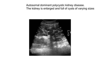 Autosomal dominant polycystic kidney disease. The kidney is enlarged and full of cysts of varying sizes  