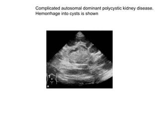 Complicated autosomal dominant polycystic kidney disease.  Hemorrhage into cysts is shown  