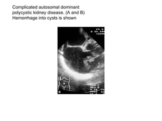 Complicated autosomal dominant  polycystic kidney disease. (A and B)  Hemorrhage into cysts is shown  
