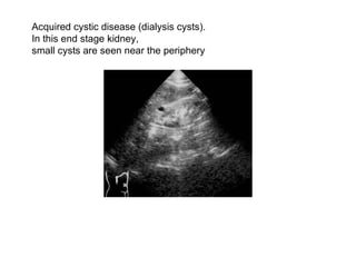 Acquired cystic disease (dialysis cysts).  In this end stage kidney,  small cysts are seen near the periphery  