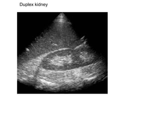 Duplex kidney  