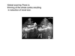 Global scarring.There is  thinning of the whole cortex,resulting in reduction of renal size  