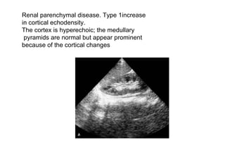 Renal parenchymal disease. Type 1increase  in cortical echodensity.  The cortex is hyperechoic; the medullary pyramids are normal but appear prominent  because of the cortical changes  