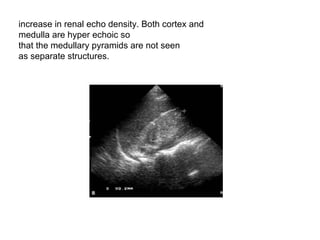 increase in renal echo density. Both cortex and  medulla are hyper echoic so  that the medullary pyramids are not seen  as separate structures.  