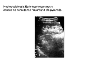 Nephrocalcinosis.Early nephrocalcinosis  causes an echo dense rim around the pyramids.  