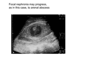 Focal nephronia may progress,  as in this case, to arenal abscess  