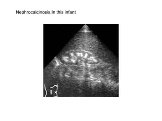 Nephrocalcinosis.In this infant  