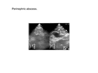 Perinephric abscess.  