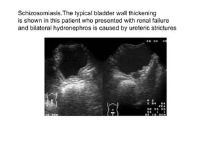 Schizosomiasis.The typical bladder wall thickening  is shown in this patient who presented with renal failure  and bilateral hydronephros is caused by ureteric strictures  
