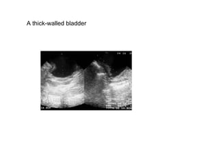 A thick-walled bladder  