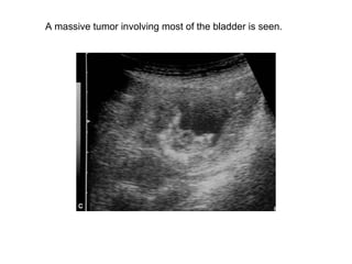 A massive tumor involving most of the bladder is seen.  