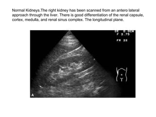 Normal Kidneys.The right kidney has been scanned from an antero lateral  approach through the liver. There is good differentiation of the renal capsule, cortex, medulla, and renal sinus complex. The longitudinal plane.  