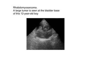 Rhabdomyosarcoma.  A large tumor is seen at the bladder base  of this 12-year-old boy  