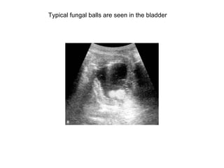 Typical fungal balls are seen in the bladder  