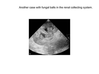 Another case with fungal balls in the renal collecting system.  
