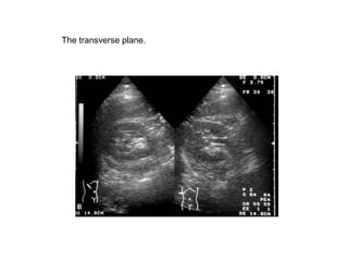 The transverse plane.  