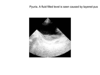 Pyuria. A fluid filled level is seen caused by layered pus  