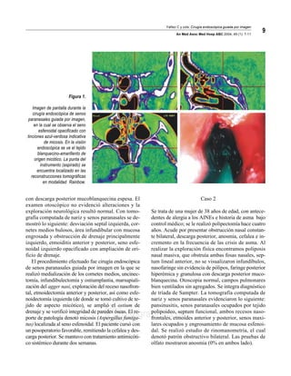 Yáñez C y cols. Cirugía endoscópica guiada por imagen
An Med Asoc Med Hosp ABC 2004; 49 (1): 7-11
9
edigraphic.com
con descarga posterior mucoblanquecina espesa. El
examen otoscópico no evidenció alteraciones y la
exploración neurológica resultó normal. Con tomo-
grafía computada de nariz y senos paranasales se de-
mostró lo siguiente: desviación septal izquierda, cor-
netes medios bulosos, área infundibular con mucosa
engrosada y obstrucción de drenaje principalmente
izquierdo, etmoiditis anterior y posterior, seno esfe-
noidal izquierdo opacificado con ampliación de ori-
ficio de drenaje.
El procedimiento efectuado fue cirugía endoscópica
de senos paranasales guiada por imagen en la que se
realizó medialización de los cornetes medios, uncinec-
tomía, infundibulectomía y ostiumplastia, marsupiali-
zación del agger nasi, exploración del receso nasofron-
tal, etmoidectomía anterior y posterior, así como esfe-
noidectomía izquierda (de donde se tomó cultivo de te-
jido de aspecto micótico), se amplió el ostium de
drenaje y se verificó integridad de paredes óseas. El re-
porte de patología denotó micosis (Aspergillus fumiga-
tus) localizada al seno esfenoidal. El paciente cursó con
un posoperatorio favorable, remitiendo la cefalea y des-
carga posterior. Se mantuvo con tratamiento antimicóti-
co sistémico durante dos semanas.
Caso 2
Se trata de una mujer de 38 años de edad, con antece-
dentes de alergia a los AINEs e historia de asma bajo
control médico; se le realizó polipectomía hace cuatro
años. Acude por presentar obstrucción nasal constan-
te bilateral, descarga posterior, anosmia, cefalea e in-
cremento en la frecuencia de las crisis de asma. Al
realizar la exploración física encontramos poliposis
nasal masiva, que obstruía ambas fosas nasales, sep-
tum lineal anterior, no se visualizaron infundíbulos,
nasofaringe sin evidencia de pólipos, faringe posterior
hiperémica y granulosa con descarga posterior muco-
blanquecina. Otoscopia normal, campos pulmonares
bien ventilados sin agregados. Se integra diagnóstico
de tríada de Sampter. La tomografía computada de
nariz y senos paranasales evidenciaron lo siguiente:
pansinusitis, senos paranasales ocupados por tejido
polipoideo, septum funcional, ambos recesos naso-
frontales, etmoides anterior y posterior, senos maxi-
lares ocupados y engrosamiento de mucosa esfenoi-
dal. Se realizó estudio de rinomanometría, el cual
denotó patrón obstructivo bilateral. Las pruebas de
olfato mostraron anosmia (0% en ambos lado).
Figura 1.
Imagen de pantalla durante la
cirugía endoscópica de senos
paranasales guiada por imagen,
en la cual se observa el seno
esfenoidal opacificado con
tinciones azul-verdosa indicativa
de micosis. En la visión
endoscópica se ve el tejido
blanquecino-amarillento de
origen micótico. La punta del
instrumento (aspirado) se
encuentra localizado en las
reconstrucciones tomográficas
en modalidad Rainbow.
 