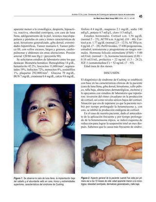 Antillón FCA y cols. Síndrome de Cushing por aplicación tópica de esteroides
An Med Asoc Med Hosp ABC 2004; 49 (1): 43-46
45
edigraphic.com
aparente menor a la cronológica, despierta, hipoacti-
va, reactiva, obesidad centrípeta, con cara de luna
llena, adelgazamiento de la piel, lesiones maculopa-
pulares y pústulas en cara y tronco características de
acné, hirsutismo generalizado, giba dorsal, extremi-
dades hipotróficas, Tanner mamario I, Tanner púbi-
co III, con vellos escasos, largos y gruesos, cardio-
pulmonar y abdomen sin otras alteraciones. Presión
arterial 120/80 mm Hg (> percentila 90).
Se solicitaron estudios de laboratorio entre los que
destacan: Biometría hemática: Hemoglobina 14 g/dL,
hematócrito 42.2%; leucocitos 11,600/mm3, segmen-
tados 19%, linfocitos 72%, monocitos 8%, eosinófilos
1%, plaquetas 292,000/mm3. Glucosa 79 mg/dL,
BUN 7 mg/dL, creatinina 0.4 mg/dL, calcio 9.6 mg/dL,
Figura 1. Se observa la cara de luna llena, la implantación baja
del cabello y el abundante vello en cara, tronco y extremidades
superiores, característicos del síndrome de Cushing.
Figura 2. Aspecto general de la paciente cuando fue vista por pri-
mera vez a los 10 meses de vida: edad aparente menor a la crono-
lógica, obesidad centrípeta, dermatosis generalizada y talla baja.
fósforo 4.4 mg/dL, magnesio 2.1 mg/dL, sodio 140
mEq/L, potasio 4.7 mEq/L, cloro 113 mEq/L.
Estudios hormonales. Cortisol a.m. 1.56 µg/dL
(normal 5 – 25), ACTH a.m. 6 pg/mL (10 – 40). Cor-
tisol p.m. 1.77 µg/dL (normal 2.5 – 12.5), ACTH p.m.
6 pg/mL (7 – 28). Perfil tiroideo, 17-OH progesterona,
estradiol, testosterona y progesterona en rangos nor-
males. Hormona folículo estimulante (FSH) = 5.00
mUI/mL (normal < 2), hormona luteinizante (LH) =
0.10 mUI/mL, proláctica = 22 ng/mL (1.3 – 24.2),
IGF-1 (somatomedina C) = 52 ng/mL (7 – 93).
Edad ósea de dos meses.
DISCUSIÓN
El diagnóstico de síndrome de Cushing se estableció
con base en las características clínicas de la paciente
(cara de luna llena, giba dorsal, hirsutismo, vello púbi-
co, talla baja, alteraciones dermatológicas, etcétera) y
lo apoyamos con estudios de laboratorio que reporta-
ron: inversión del ritmo circadiano en la producción
de cortisol, así como niveles séricos bajos del cortisol.
Situación que era de esperarse ya que la paciente reci-
bió por tiempo prolongado la betametasona y, con
esto, se inhibió la producción endógena de cortisol.
En el caso de nuestra paciente, dado el anteceden-
te de la aplicación frecuente y por tiempo prolonga-
do de la betametasona tópica, se indicó esquema de
reducción para lograr la suspensión total un mes des-
pués. Sabemos que la causa más frecuente de síndro-
 