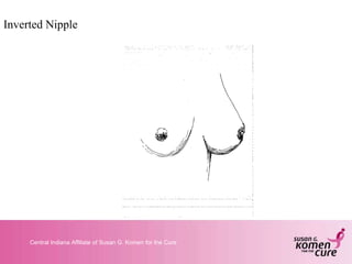 Inverted Nipple 