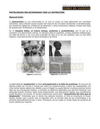 PATOLOGIAS RELACIONADAS CON LA NUTRICIÓN
Desnutrición
La desnutrición es una enfermedad en la cual el cuerpo no está obteniendo los nutrientes
suficientes. Esta condición puede resultar del consumo de una dieta insuficiente o mal balanceada,
por trastornos digestivos, problemas de absorción u otras condiciones médicas. Existen dos tipos
de desnutrición. El Marasmo y el Kwashiorkor.
En el marasmo faltan, al mismo tiempo, proteínas y carbohidratos, por lo que se la
considera una desnutrición crónica, el individuo está en equilibrio, aunque bastante enflaquecido,
con falta de ánimo y con muy poca actividad (al niño se le ven las costillas), pero no hay daño
hepático. Esta desnutrición es típica de Etiopía y de África.

Figura 7. Marasmo.

Figura 8. Kwashiorkor

La enfermedad de kwashiorkor se debe principalmente a la falta de proteínas. El consumo de
calorías puede ser normal e incluso por sobre los requerimientos a partir de carbohidratos, los
niños tienen edema abdominal, debido a que el hígado no puede fabricar muchas proteínas (entre
ellas las que transportan lípidos), ni tampoco la albúmina plasmática que permite mantener una
adecuada presión oncótica. Estos niños experimentan una desnutrición aguda, que normalmente
puede llevarlos a la muerte. El nombre kwashiorkor quiere decir “desnutrición del niño que es
desplazado”. Entiéndase que en donde hay pobreza extrema, el niño se amamanta el mayor
tiempo posible, pero cuando nace el siguiente niño, el primero deja de ser amamantado y se
alimenta esencialmente de pan y otros farináceos, de los cuales no recibe todas las proteínas de
buena calidad que requiere.

20

 