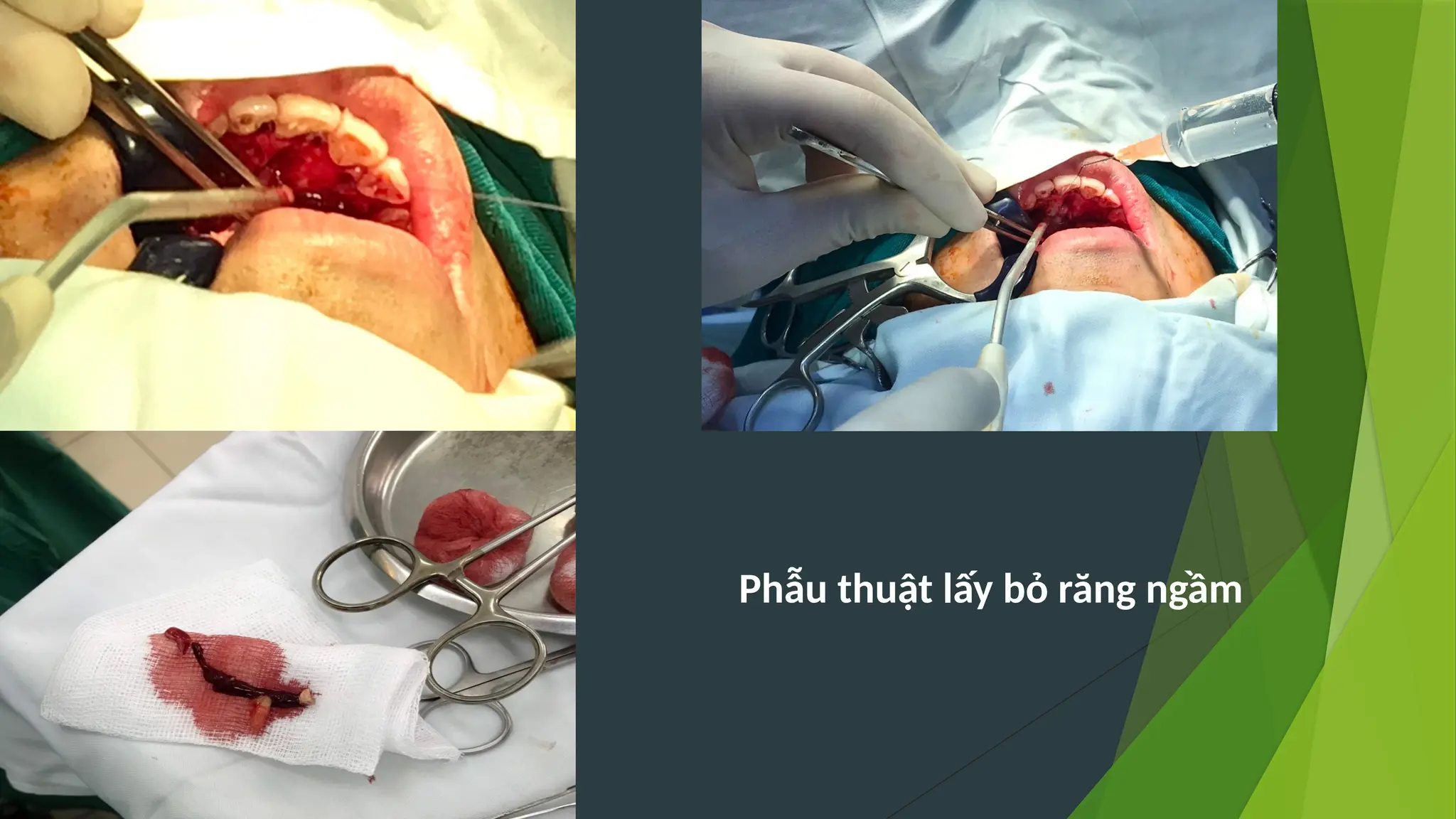 Phẫu thuật lấy bỏ răng ngầm
 