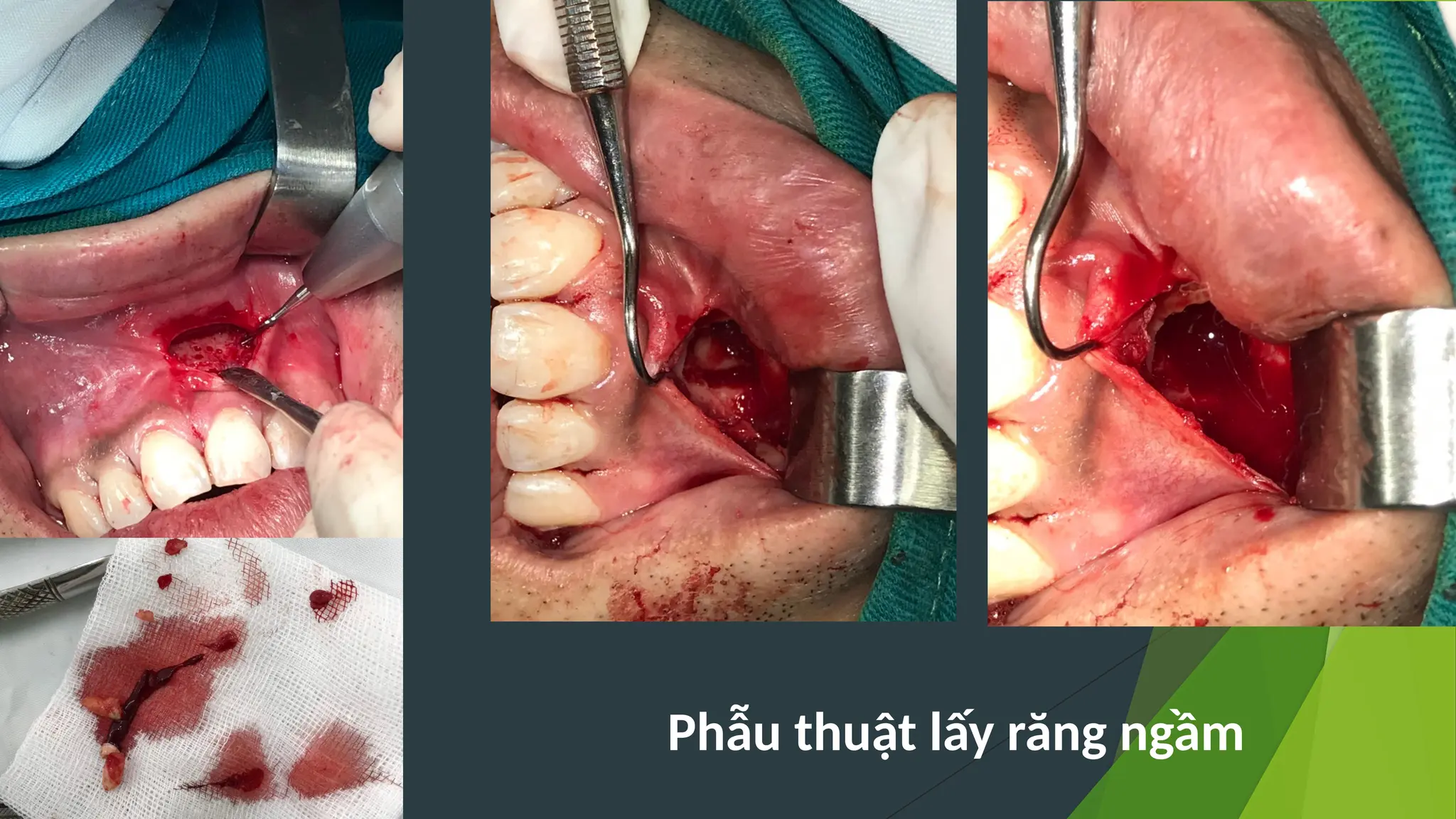 ĐI U TR
Ề Ị
Phẫu thuật lấy răng ngầm
 