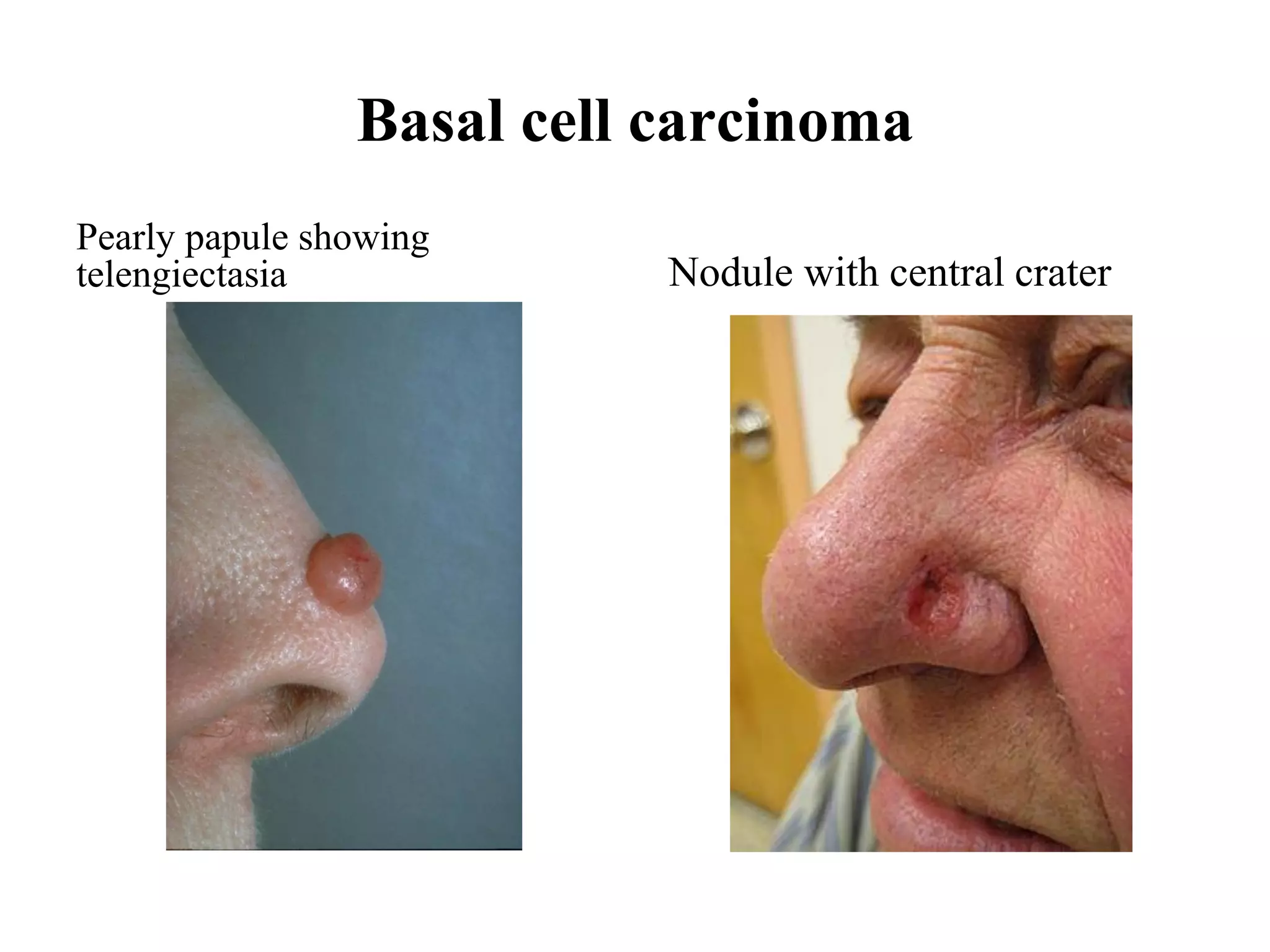 Basal cell carcinoma
Pearly papule showing
telengiectasia Nodule with central crater
 